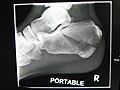 Fractured calcaneus post falling 8 feet of roof.
