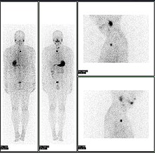 Iodine-123 whole body scan for thyroid cancer evaluation. The study above was performed after the total thyroidectomy and TSH stimulation with thyroid hormone medication withdrawal. The study shows a small residual thyroid tissue in the neck and a mediastinum lesion, consistent with the thyroid cancer metastatic disease. The observable uptakes in the stomach and bladder are normal physiologic findings. Iodine wb scan.jpg