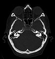 Craniale Computertomographie Abgebildet sind Felsenbein und Nasennebenhöhlen. Aufgrund der hohen Auflösung der Aufnahme des verwendeten 64-Zeilen-CTs sind selbst die Gehörknöchelchen erkennbar.