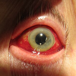 Человеческий глаз показывает субконъюнктивальное кровоизлияние. Jpg