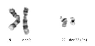 Philadelphias Translution T (9; 22) (Q34; Q11.2) visto in leucemia mielogena cronica.