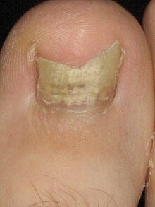 Nail candidiasis (onychomycosis) Toefungus.jpg