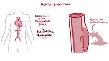 ファイル:Aortic dissection.webm