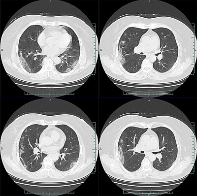 Przykładowe zdjęcie CT osoby z obustronnym zapaleniem płuc w przebiegu COVID-19.