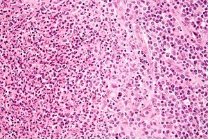 Біоптат лімфатичного вузла з великою кількістю Bartonella henselae, з гранульомами (бліді клітини у правій частині зображення) й мікроабсцесами з нейтрофілів зліва від центру. (фарбування гематоксилін-еозином, велике збільшення)