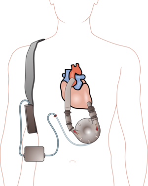 English: Ventricular assist device