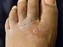 Athlete's foot Athlete's foot.JPG