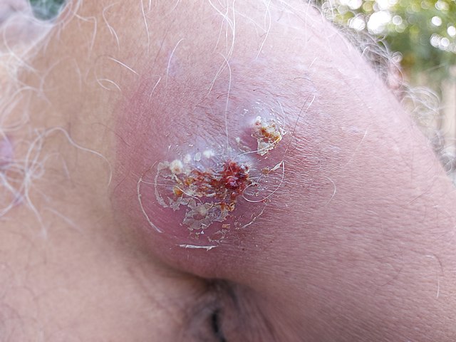 face antérieure de l'épaule d'un patient âgé présentant un amas de furoncles dont certains ont éclatés formant un amas très inflammatoire et d'autres sont encore à l'état de pustules