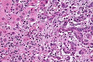 Cholangiocarcinoma - very high mag.jpg