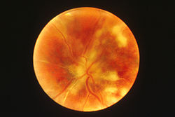 Photograph taken of the back of the eye (تنظير قاع العين) of an إيدز patient with chorioretinitis.