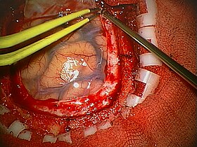 Craniotomy Arachnoid.jpg