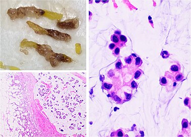 Carcinoma mucinoso de mama: La patología macroscópica (arriba a la izquierda) del carcinoma mucinoso muestra áreas gelatinosas. La histopatología muestra grupos o nidos de células tumorales flotando en depósitos de mucina extracelular.[3]​