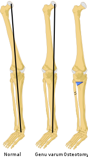 Miniatura para Osteotomía