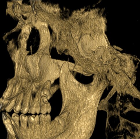 http://upload.wikimedia.org/wikipedia/commons/thumb/2/2e/Severely_impacted_wisdom_tooth_CT_scan_-_upper_right.jpg/483px-Severely_impacted_wisdom_tooth_CT_scan_-_upper_right.jpg