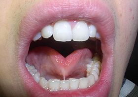 Frenulum linguae.jpg