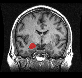 English: MRI coronal view of the amygdala