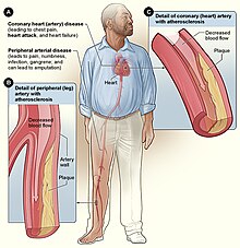Smoking can cause atherosclerosis, leading to coronary artery disease and peripheral arterial disease. Smoking and Atherosclerosis.jpg