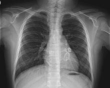 X-ray showing aneurysmal enlargement of the coronary arteries, which is a complication in a Kawasaki syndrome Verkalkte aneurysmatische Coronarien.jpg