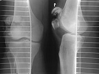 แบบแตกละเอียด (Comminuted fracture of patella)