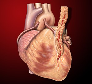Three coronary artery bypass grafts, a LIMA to...