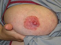 Paget's disease of the nipple[৫]