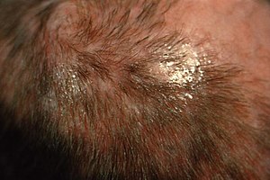 ID#:4809 - : The favus on this patient’s scalp...
