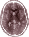 Einzelbild einer Magnetresonanz- tomographie eines menschlichen Gehirns; Animierte Version mehrerer transversaler Schnittebenen