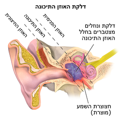 דלקת אוזן תיכונה