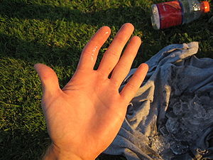 Photograph of dislocated left index finger