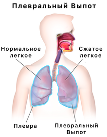 Плевральный Выпот