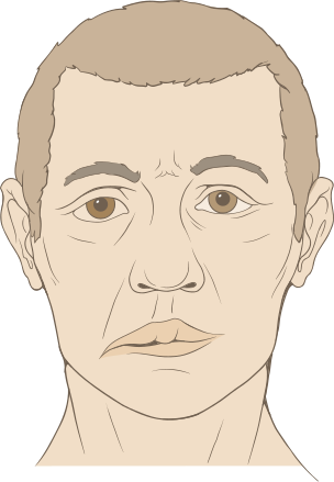 external image 304px-Bells_palsy_diagram.svg.png