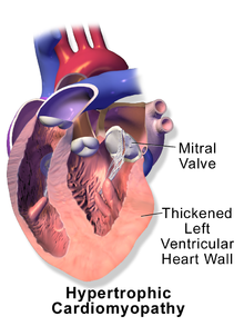 Blausen 0166 Кардиомиопатия Hypertrophic.png