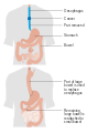 An esophagectomy using the bowel (colon) to replace the esophagus