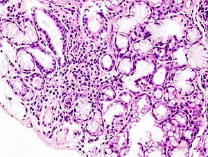 Синдром на Sjogren (2) .jpg