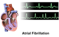 V srdci staršího člověka vznikla fibrilace síní. Namísto pravidelného stahování (horní záznam) se část srdce chvěje a ryrmus srdce je nepravidelný (dolní záznam).