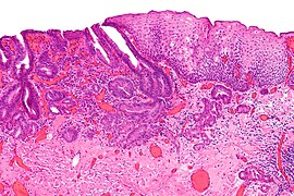 Mikrografija histopatološkog nalaza adenokarcinoma jednjaka (tamnoplavi – gornji levi deo slike) i normalnog skvamoznog epitela (gore desno na slici)