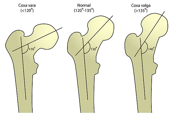 ... , plural h(a)emarthroses) is a bleeding into joint spaces