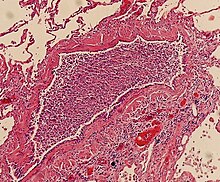 Histopathology of bronchopneumonia, showing neutrophils filling a bronchiole. Histopathology of bronchopneumonia.jpg