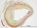 Tintura de Movat que muestra estenosis luminal en aterosclerosis de una arteria coronaria.