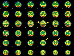 Afektivní psychóza, Hashimotova tyreoiditida a abnormality perfuze mozku.jpg