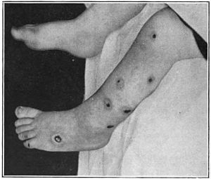 An introduction to dermatology (1905) ecthyma.jpg