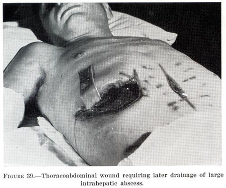 Торакоабдоминальная рана, требующая последующего дренирования большого внутрипечёночного абсцесса