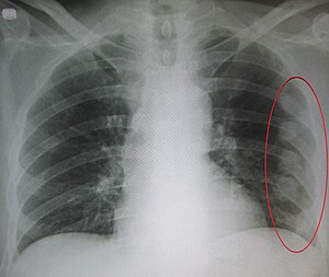 An X ray showing multiple old fractured ribs o...