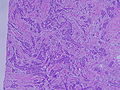 Histopathology of invasive ductal carcinoma of the breast. H&E stain.