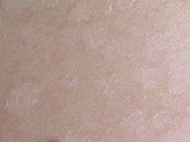 Pityriasis versicolor