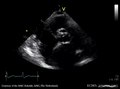 Soubor: Stenóza těžké aortální chlopně E00275 (CardioNetworks ECHOpedia) .webm