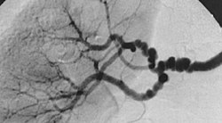 The "string-of-beads" feature in multi-focal fibromuscular dysplasia. The sign is caused by areas of relative stenoses alternating with small aneurysms.