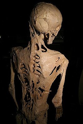 Скелет человека, страдавшего ФОП