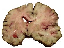 A slice of brain from the autopsy of a person who had an acute middle cerebral artery (MCA) stroke MCA-Stroke-Brain-Human-2.JPG
