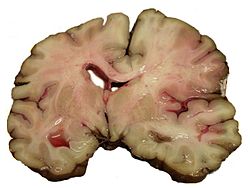 Akut középső agyi artériakárosodást (arteria cerebri media, artériaelzáródást) elszenvedett ember boncolásából származó agyszelet